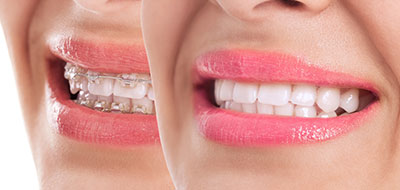 The image displays a woman s face with a large smile, featuring pink lipstick, and there are two smaller images within it showing her teeth and lips from different angles.