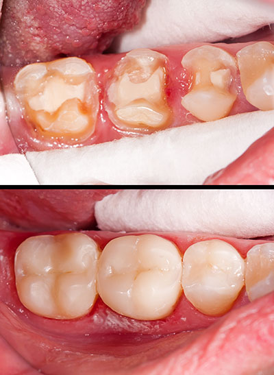 The image shows a close-up view of a person s mouth with severe dental decay and damage, emphasizing oral health issues.