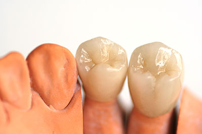 The image shows a collection of artificial teeth displayed against a white background, with varying shades of tooth enamel and dental implants.