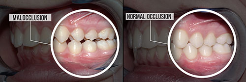 The image shows a side-by-side comparison of two dental X-rays, with the top X-ray labeled  Malocclusion  and the bottom one labeled  Normal occlusion,  highlighting the differences in tooth alignment and positioning.
