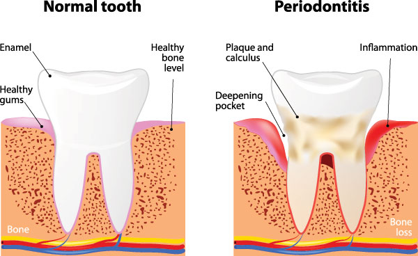 The image shows a diagrammatic representation of tooth decay progression, with labels indicating  Normal,   Periodontitis,  and  Bone loss  stages, highlighting the effects on teeth and gums, including the use of an enamel-strengthening pocket and the presence of inflammation and bone loss.