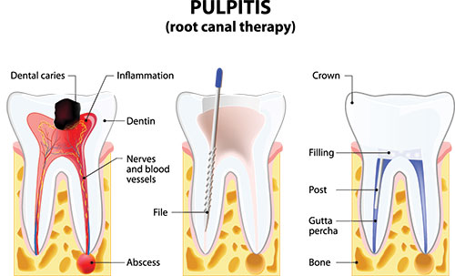 The image is a detailed medical illustration showing three stages of pulpitis in a tooth  initial inflammation, progression with dental caries, and advanced infection with visible swelling around the tooth.