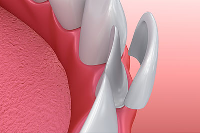 The image displays a close-up view of a human tooth with a focus on its surface and gumline, set against a blurred background that appears to be a medical setting.