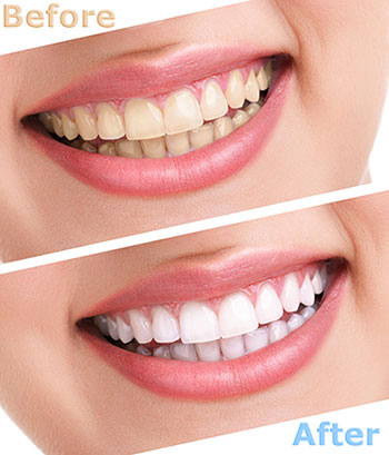 The image shows a person s teeth before and after a cosmetic dental treatment, with a smiling expression and a clear focus on oral hygiene and dental care services.