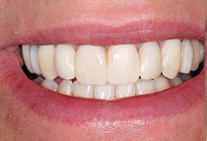 The image shows a close-up of a person s smiling face with straight white teeth.