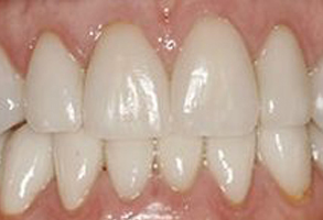 The image shows a close-up view of a person s teeth with a focus on a large gap between the upper front teeth, which appear to be white, and the lower teeth, which are discolored and have yellow stains.