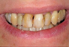 The image shows a close-up view of a person s teeth with yellow stains, which suggests poor oral hygiene.
