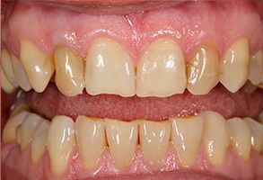 The image shows a close-up of a person s teeth with yellow staining and some tooth decay visible.